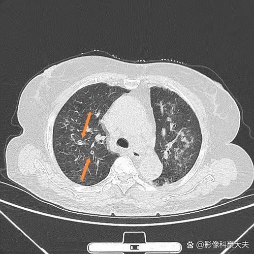 【山东省泰安市岱岳区今冬新增24例境外输入病例_泰安岱岳区新冠肺炎】