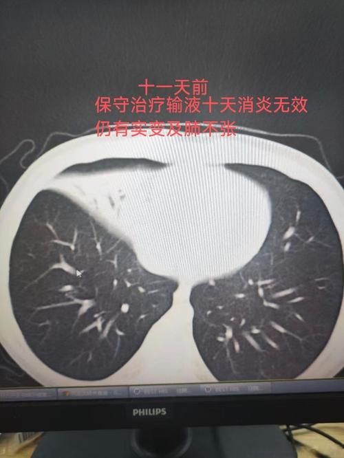 福建福州福清累计报告重症5例/福清疑似肺炎1例